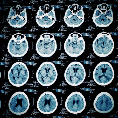 brain injury